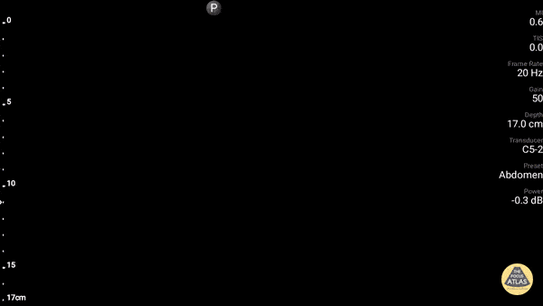 Pulmonary - Lung Curtain