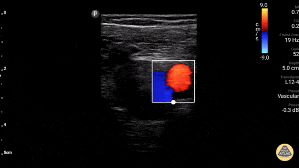 Vascular - Great Saphenous Vein