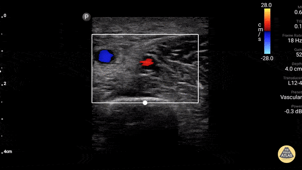 Vascular - Axillary Vein (Normal Compressible)