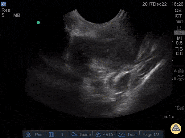 Soft Tissue - Peritonsillar Abscess