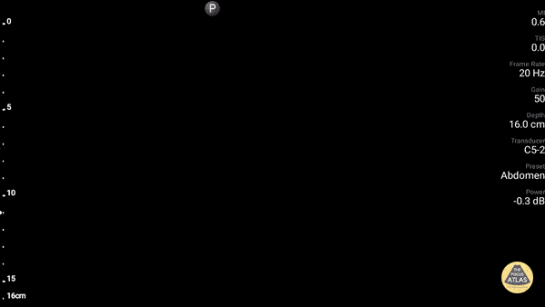 Bowel-GI - Hepatic Cysts