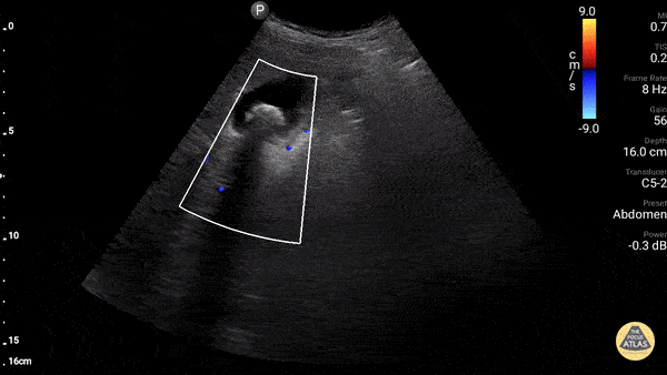 Biliary - Portal Triad