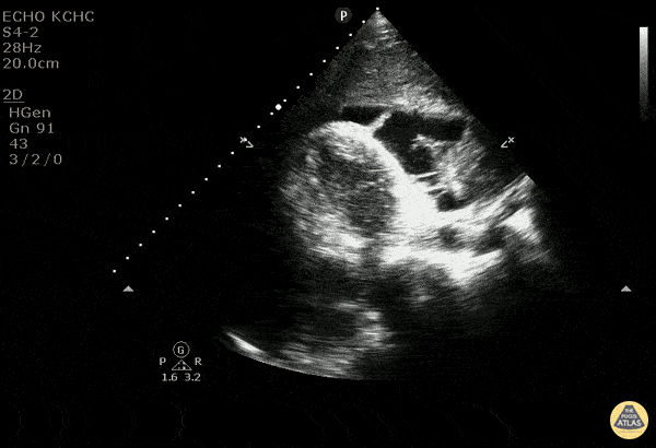 Pericardial Disease - Malignant Pericardial Effusion
