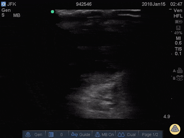 Renal/GU - Testicular Rupture