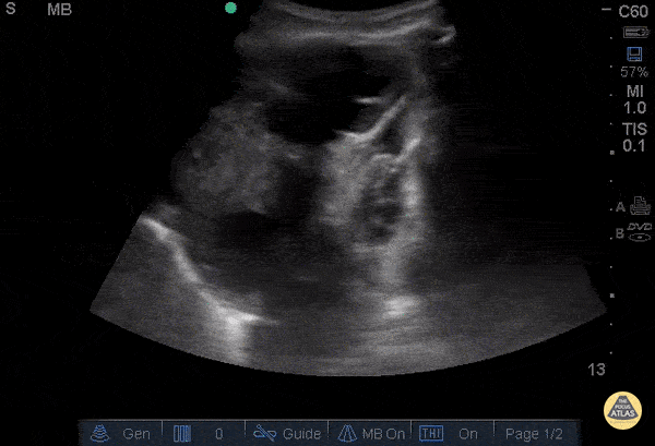 Pulmonary - Malignant Pleural Effusion