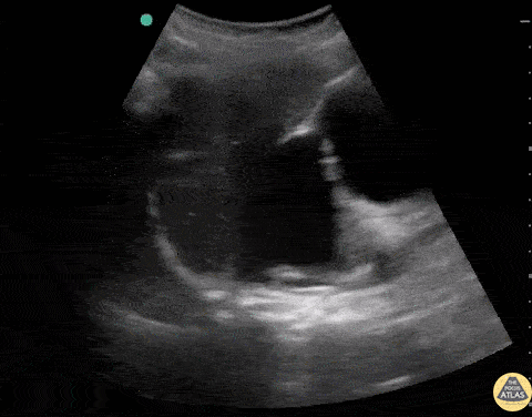 Renal/GU - Severe Hydronephrosis with Massive Hydroureter