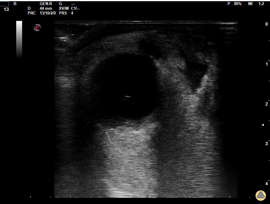 Orbital - Orbital Abscess