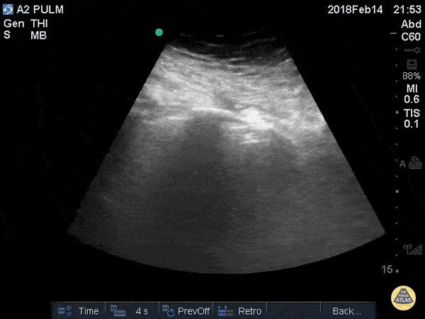 Pulmonary - Lung Point