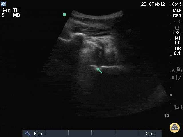 Musculoskeletal - Shoulder Dislocation