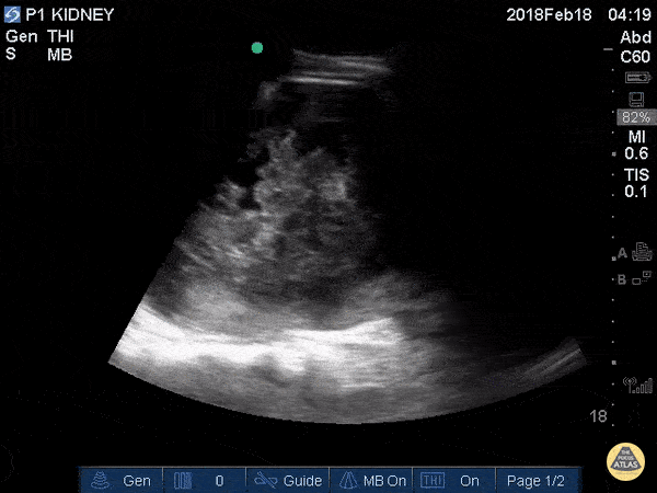 Renal/GU - Traumatic Kidney Hematoma