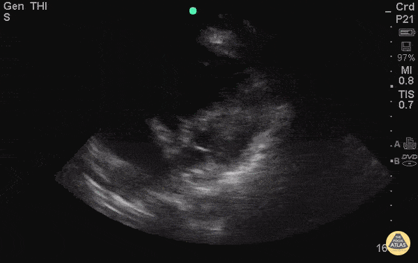 Right Ventricular Dysfunction - RA Thrombus with R Heart Strain