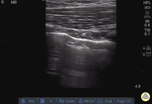 Pulmonary - Pulmonary Contusion