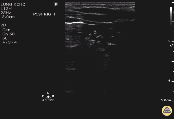 Peds-Lung - C-lines - Pneumonia