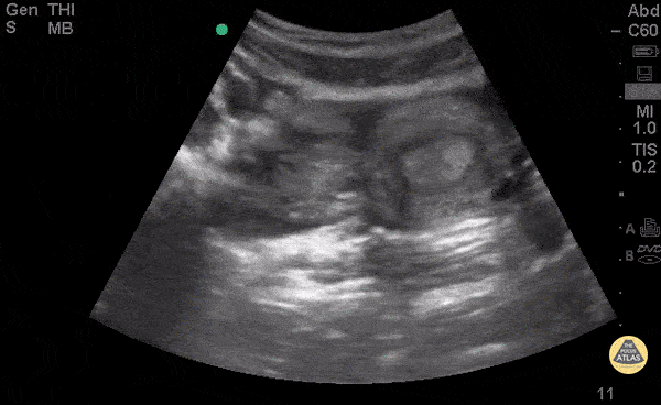 OB/Gyn - Hemorrhagic Ovarian Cyst
