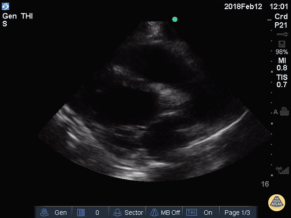 Left Ventricular Dysfunction - Decreased EF (Parasternal Long)