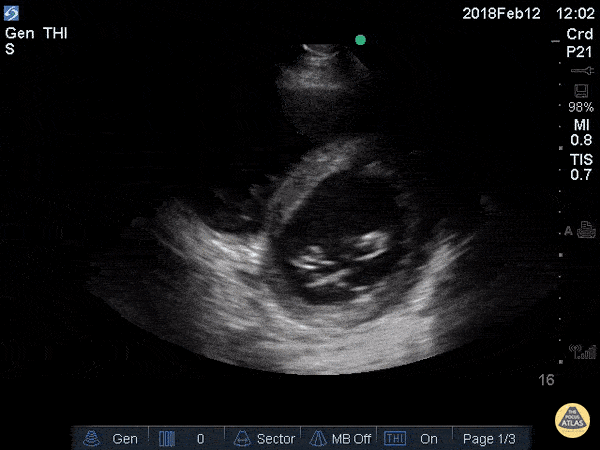 Left Ventricular Dysfunction - Decreased EF (Parasternal Short)