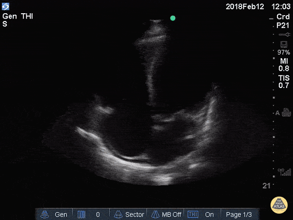 Left Ventricular Dysfunction - Reduced EF (Apical 4 Chamber)