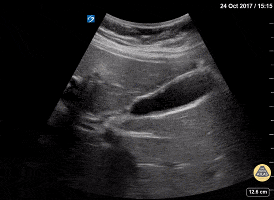 Biliary - Adenomyomatosis