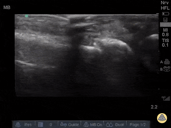 Musculoskeletal - Metacarpal Fracture