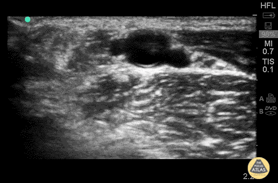 Vascular - Radial Artery Thrombus (Pre/Post TPA)