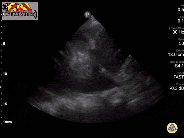 Pulmonary - Pleural Effusion