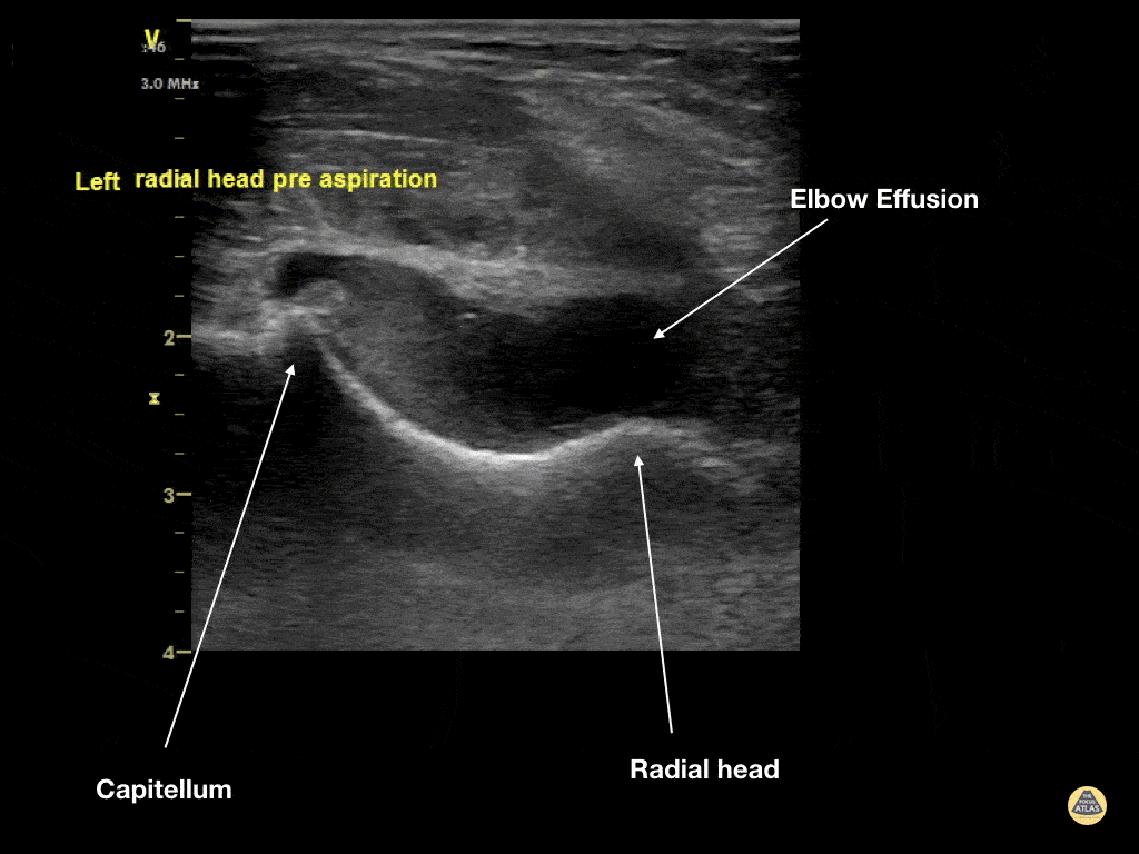 Musculoskeletal - Elbow Effusion (Traumatic)