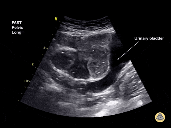 Bowel-GI - Small Bowel Obstruction