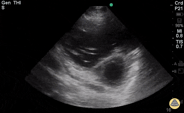 Right Ventricular Dysfunction - Right-Sided Heart Failure (PSAX)