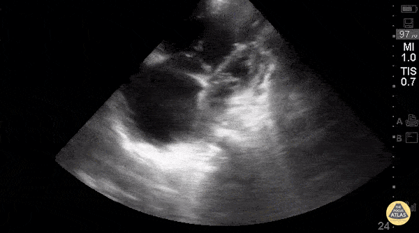 Right Ventricular Dysfunction - Right-Sided Heart Failure (A4C)