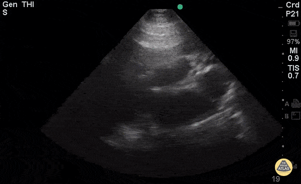 Right Ventricular Dysfunction - Right-Sided Heart Failure (PLAX)