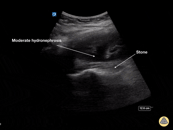 Renal/GU - Moderate Hydronephrosis