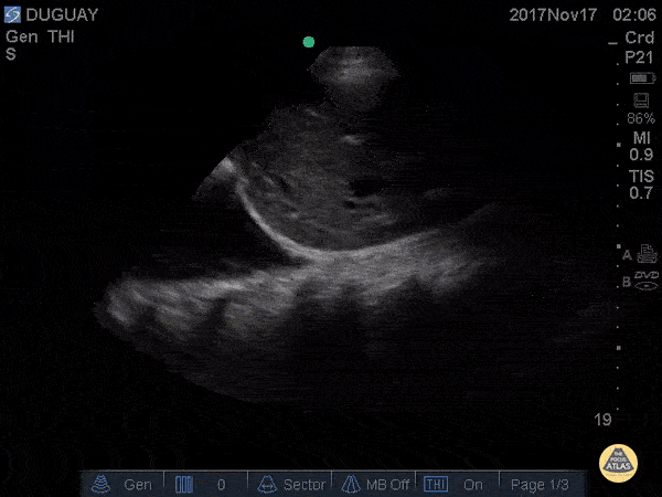 Pulmonary - Spine Sign - Pleural Effusion