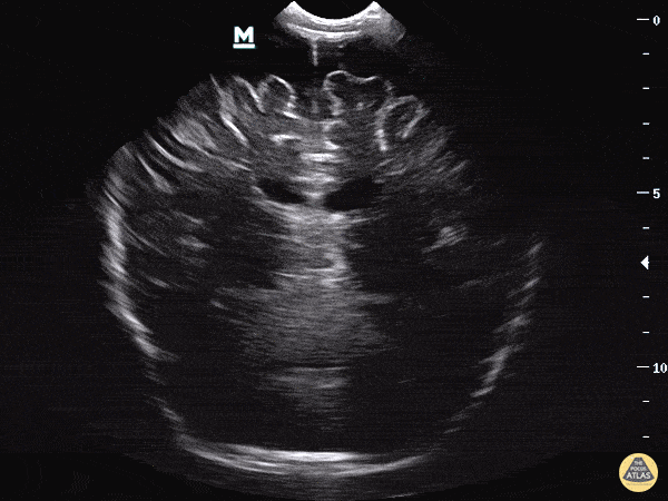 Pediatrics - Hydrocephalus - Extra axial Fluid