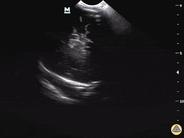 Blog - The Altered Infant - Should we POCUS an open fontanelle? A case of Hydrocephalus