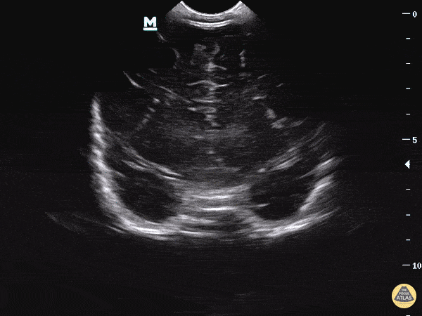 Blog - The Altered Infant - Should we POCUS an open fontanelle? A case of Hydrocephalus