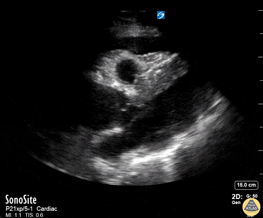 Pericardial Disease - Aortic Dissection with Tamponade - Parasternal Long