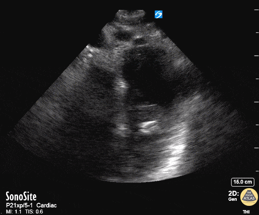 Thoracic Aortic Dissection & Aneurysm - Aortic Dissection On Suprasternal View