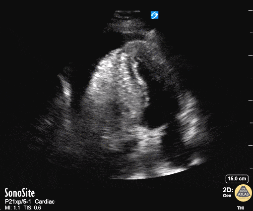 Pericardial Disease - Aortic Dissection with Tamponade - Apical