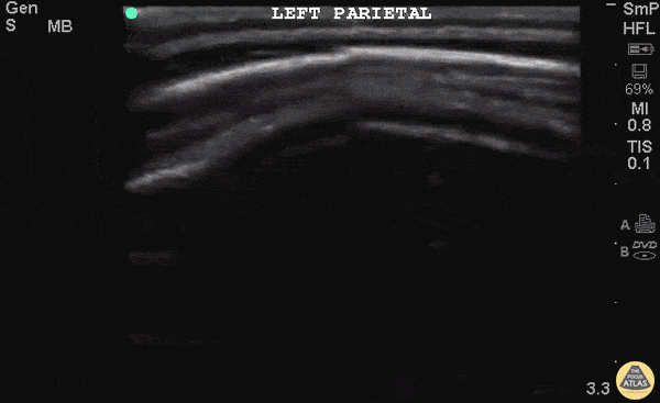 Pediatrics - Skull Fracture - Pediatrics