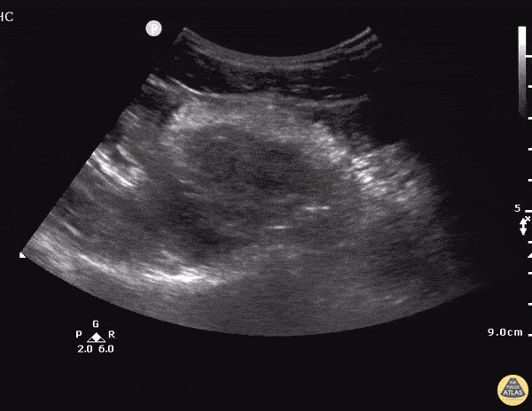OB/Gyn - Ectopic - Ruptured Cornual Ectopic Pregnancy - Longitudinal