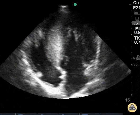 Pediatrics - HOCM - Hypertrophic Obstructive Cardiomyopathy