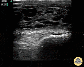 Musculoskeletal - Suprapatellar Bursitis