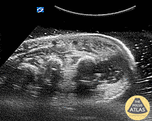 Musculoskeletal - Hand Abscess (Periosteal)