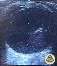 Orbital - Posterior Vitreous Hemorrhage