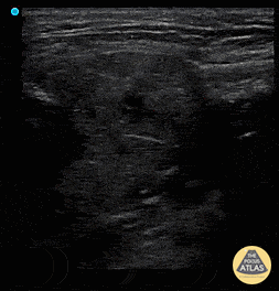 Soft Tissue - Sialadenitis