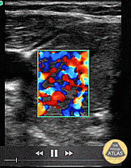Soft Tissue - Thyroid Storm (Inferno Sign)