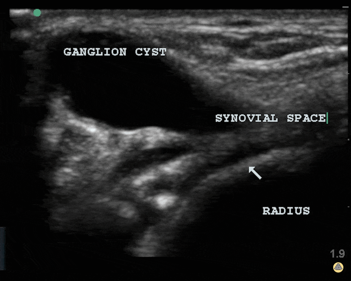 Musculoskeletal - Ganglion Cyst