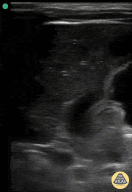 Peds-Gastrointestinal - Pyloric Stenosis