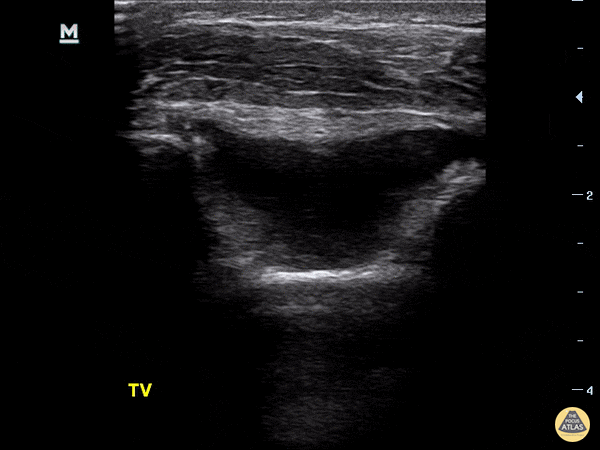Pediatrics - Supracondylar Fracture