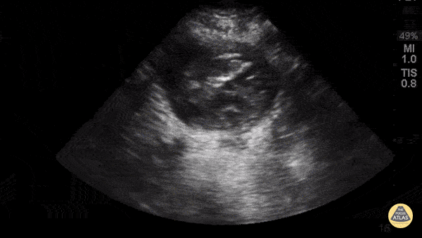 Aorta - Aorta Posterior Wall Rupture
